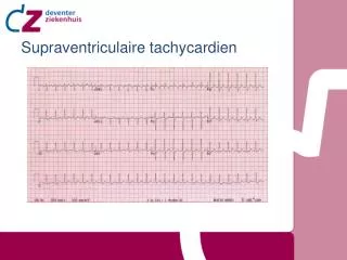supraventriculaire tachycardien