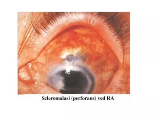 Scleromalasi (perforans) ved RA