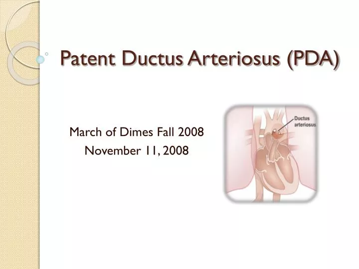 patent ductus arteriosus pda
