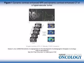 Figure 1 Dynamic contrast-enhanced MRI and dynamic contrast-enhanced CT of a hypervascular tumor