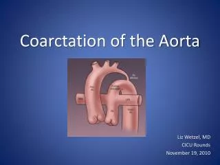 C oarctation of the Aorta