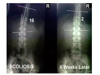 Unhealthy reversed curve in neck Normal, healthy curve in neck