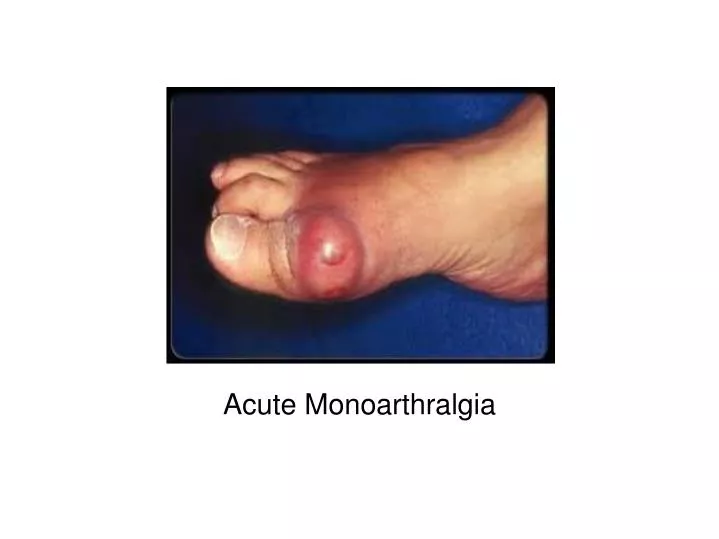 acute monoarthralgia