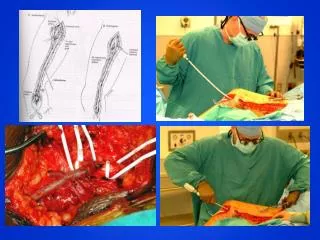 Above the Knee Heparin Bonded PTFE Bypass