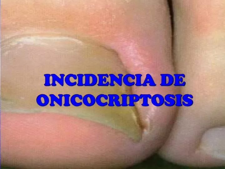 incidencia de onicocriptosis