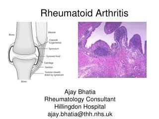 Rheumatoid Arthritis