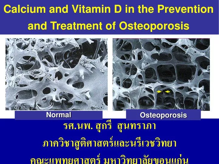 calcium and vitamin d in the prevention and treatment of osteoporosis