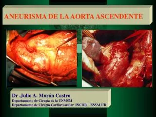aneurisma de la aorta ascendente