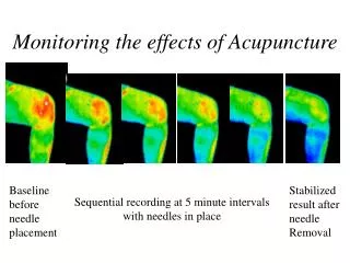 Monitoring the effects of Acupuncture