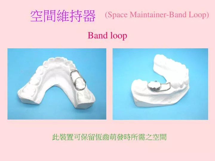 space maintainer band loop