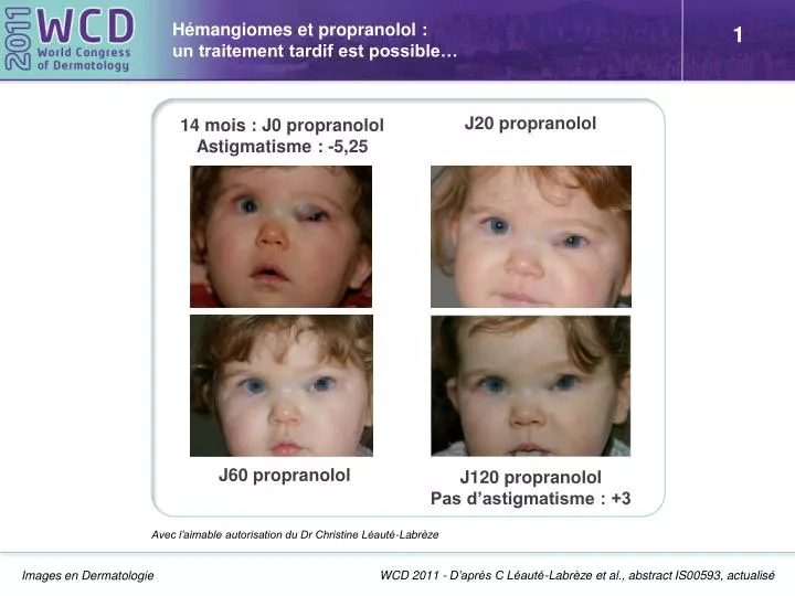 h mangiomes et propranolol un traitement tardif est possible