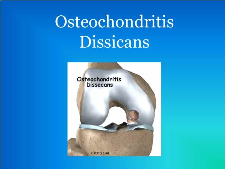 osteochondritis dissicans