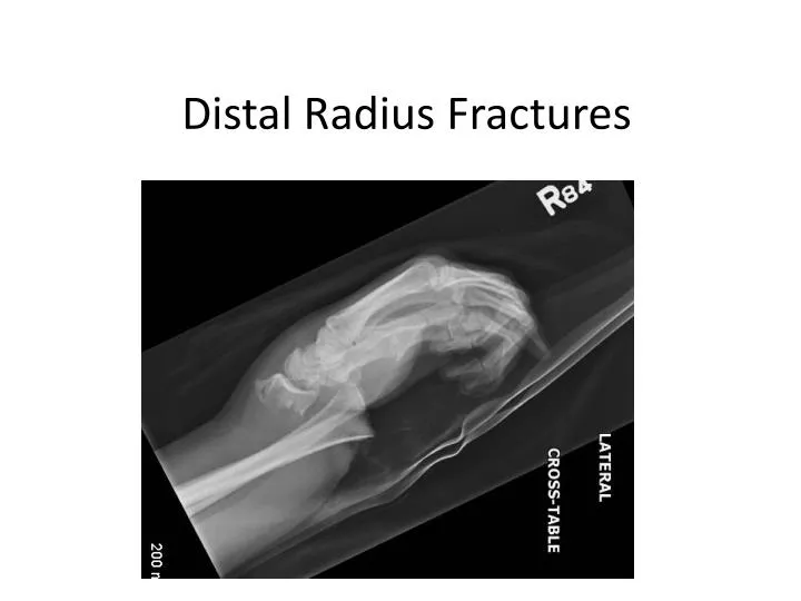 distal radius fractures