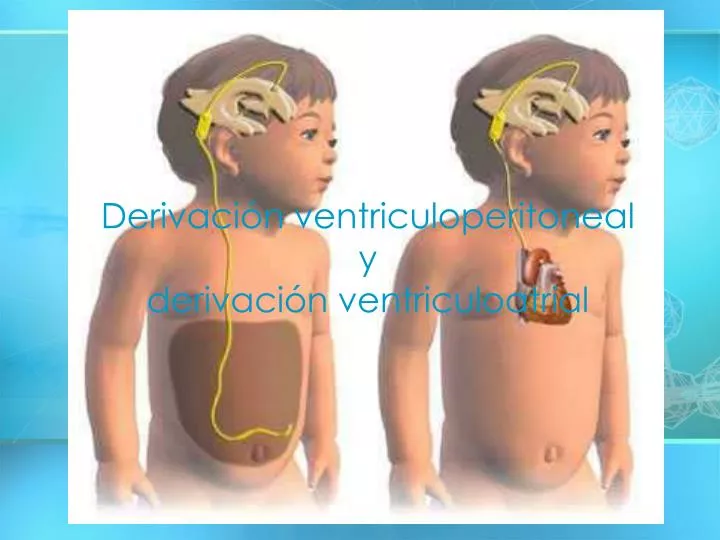 derivaci n ventriculoperitoneal y derivaci n ventriculoatrial