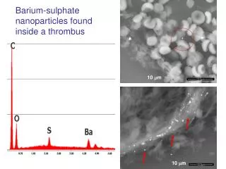 Barium-sulphate nanoparticles found inside a thrombus