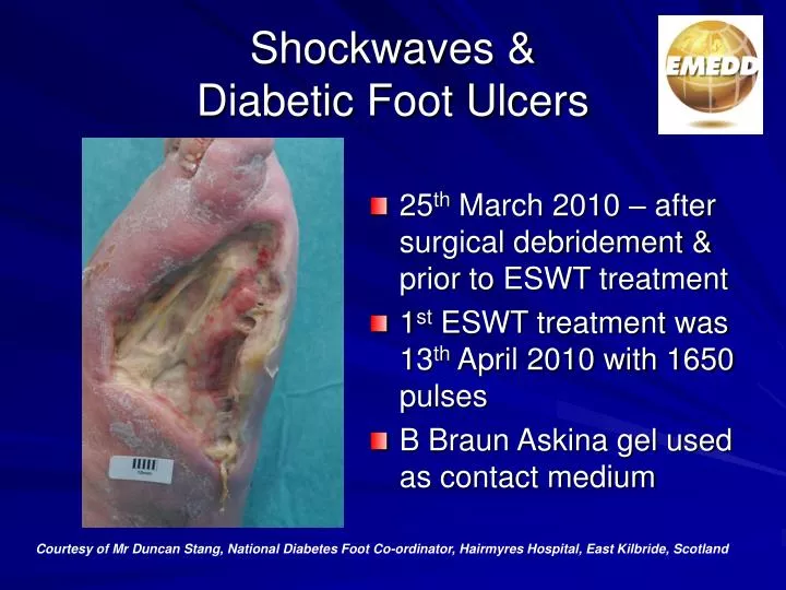 shockwaves diabetic foot ulcers