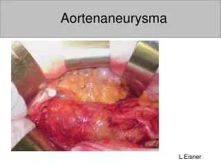 aortenaneurysma