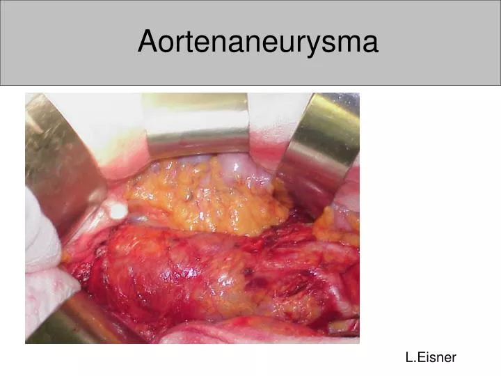 aortenaneurysma