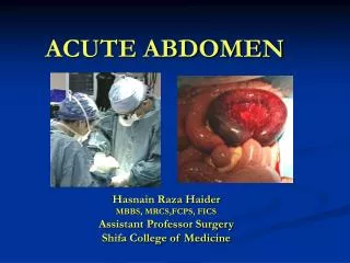 ACUTE ABDOMEN