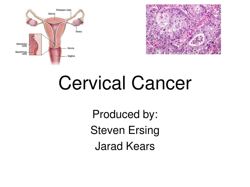 PPT - Cervical Cancer PowerPoint Presentation, free download - ID:4099365