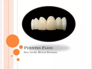 puentes fijos