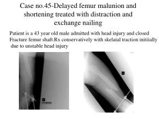 Case no.45-Delayed femur malunion and shortening treated with distraction and exchange nailing