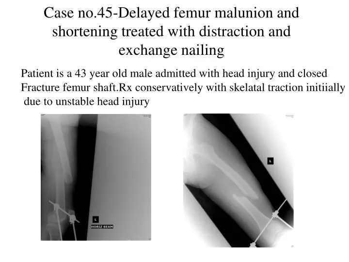 Peri-implant fracture treated with nail removal and a exchange nailing... |  Download Scientific Diagram