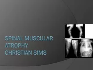 Spinal Muscular Atrophy CHRISTIAN SIMS