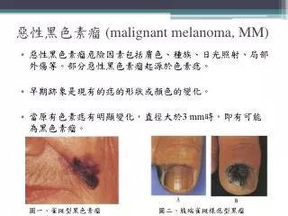 malignant melanoma mm