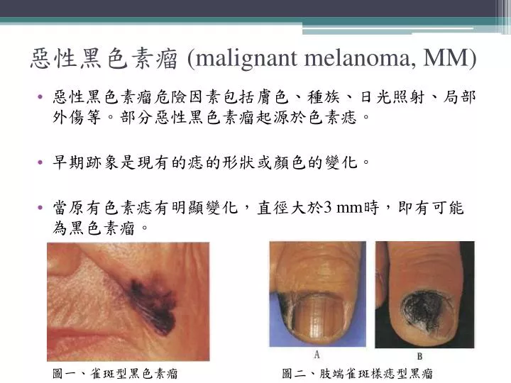 malignant melanoma mm