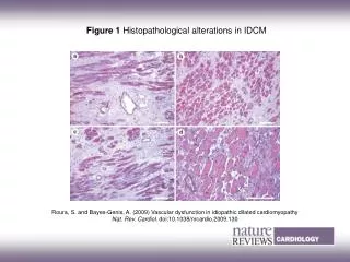 Figure 1 Histopathological alterations in IDCM