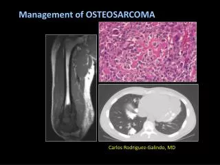 Management of OSTEOSARCOMA