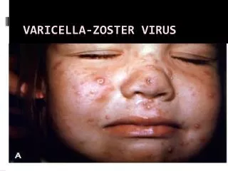 Varicella -zoster virus