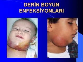der n boyun enfeks yonlari