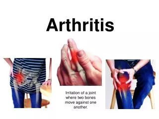 PPT - Arthritis PowerPoint Presentation, Free Download - ID:1383571