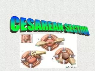 CESAREAN SECTION