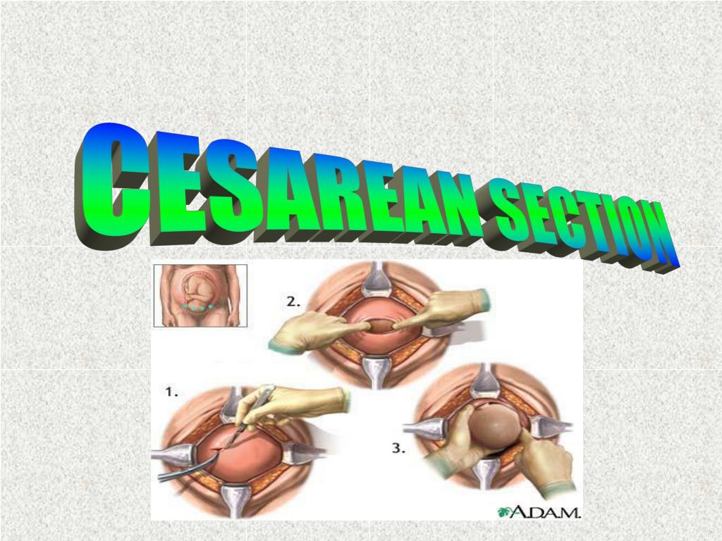 PPT - CESAREAN SECTION PowerPoint Presentation, free download - ID:4218589