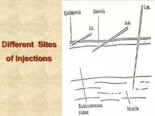 Different Sites of Injections