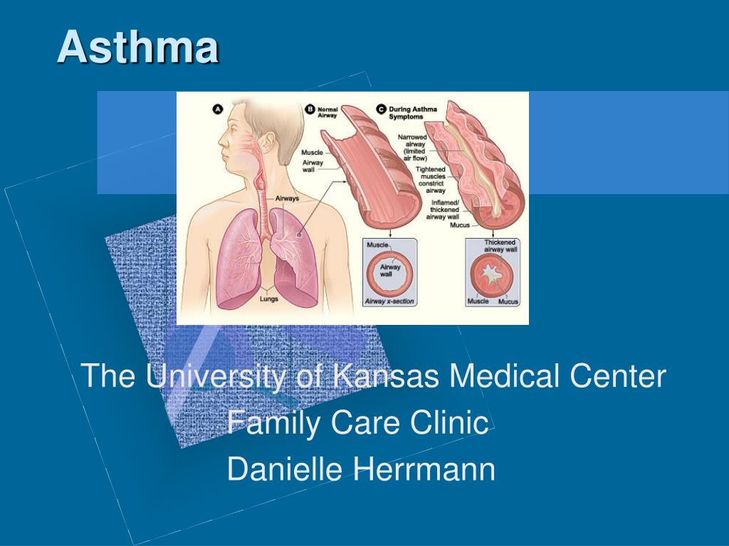 PPT - Asthma PowerPoint Presentation, free download - ID:4225849