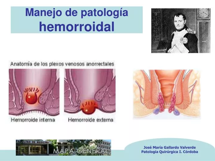 manejo de patolog a hemorroidal