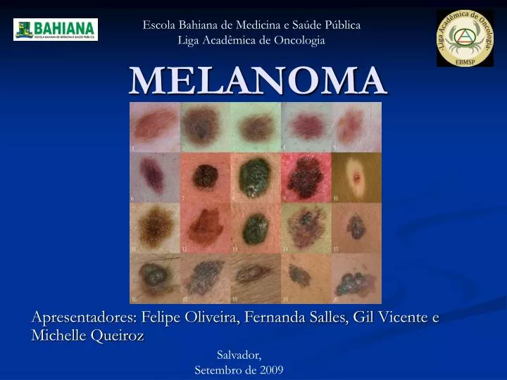 melanoma