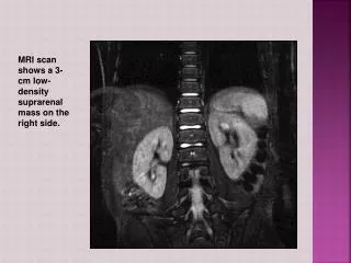 MRI scan shows a 3-cm low-density suprarenal mass on the right side.