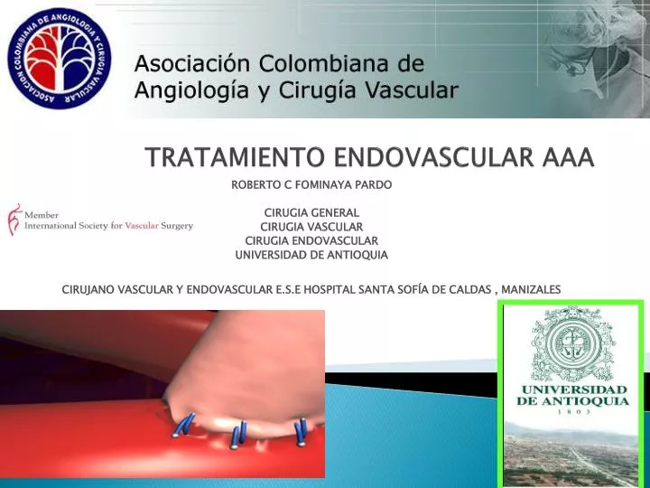 tratamiento endovascular aaa