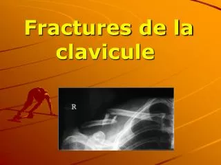 fractures de la clavicule