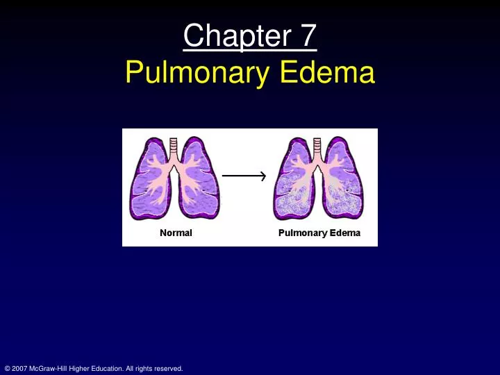 chapter 7 pulmonary edema