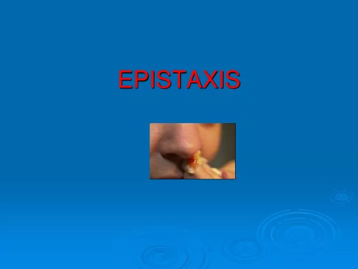 epistaxis by