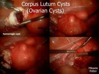 Corpus Lutum Cysts 	 (Ovarian Cysts)