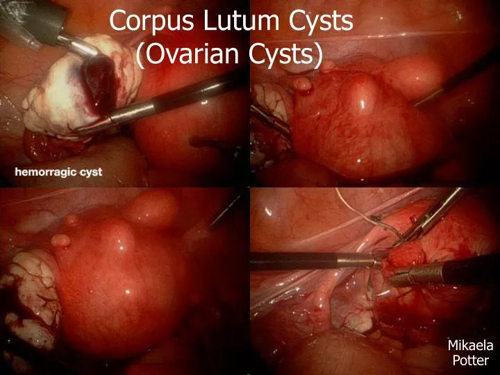 corpus lutum cysts ovarian cysts