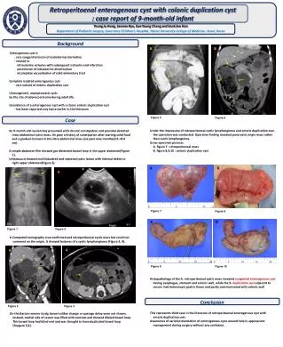 Retroperitoenal enterogenous cyst with colonic duplication cyst
