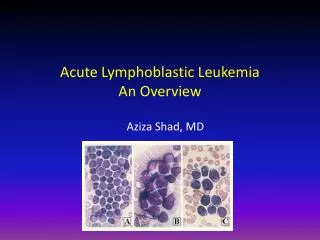 Acute Lymphoblastic Leukemia An Overview